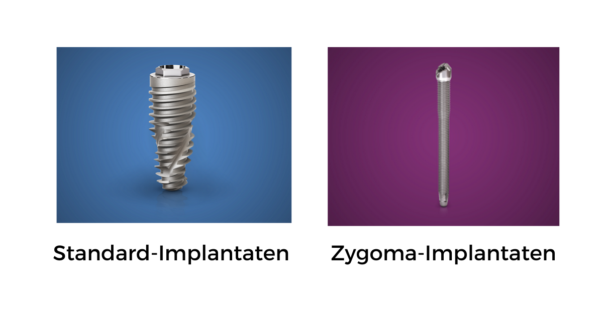 Zygoma-Implantate